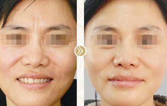 遂寧微針填充動態(tài)細紋整形機構前十名單