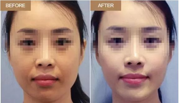 菏澤哪家整形醫(yī)院自體脂肪移植口碑最佳？排行榜公布！