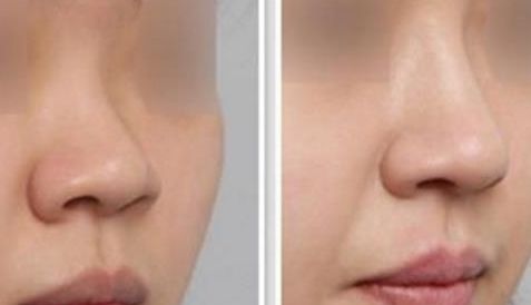 廣州最佳假體隆胸醫(yī)院排名公布，美萊、曙光享有盛譽(yù)再登榜首