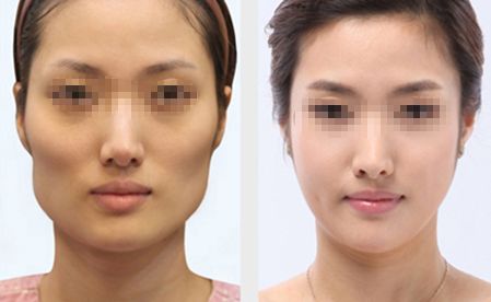 三亞V形曲線面部重塑：權(quán)威醫(yī)院口碑排行榜揭曉！