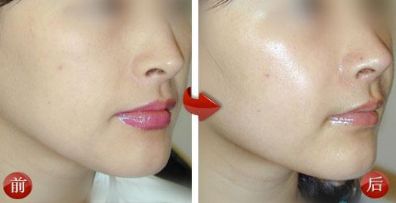 溫州口碑佳，眼部皺紋修復有良方