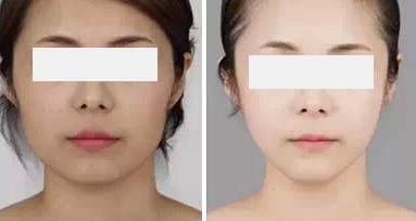 沈?yàn)槊竦男夭控S滿術(shù)表現(xiàn)如何？