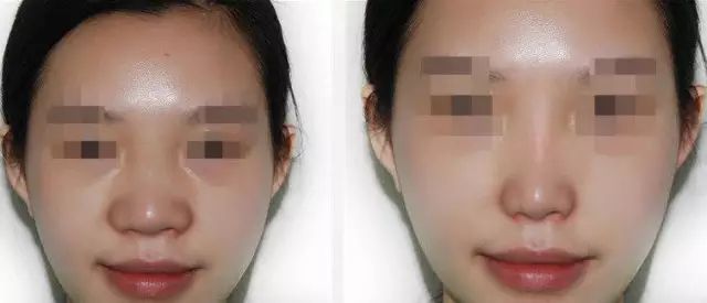 深圳水動(dòng)力吸脂瘦腰整形醫(yī)院口碑推薦：權(quán)威專家榜單