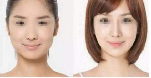 探尋蕭山哪家整形醫(yī)院針雕肥胖紋效果最佳？