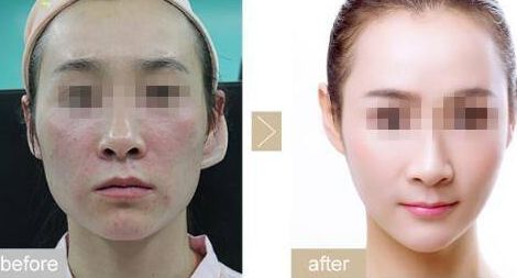 承德哪家祛痘坑醫(yī)院效果好？排名榜前10強(qiáng)資質(zhì)評(píng)測(cè)