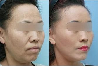 鞍山點(diǎn)陣激光祛疤痕醫(yī)院排名前10強(qiáng)！