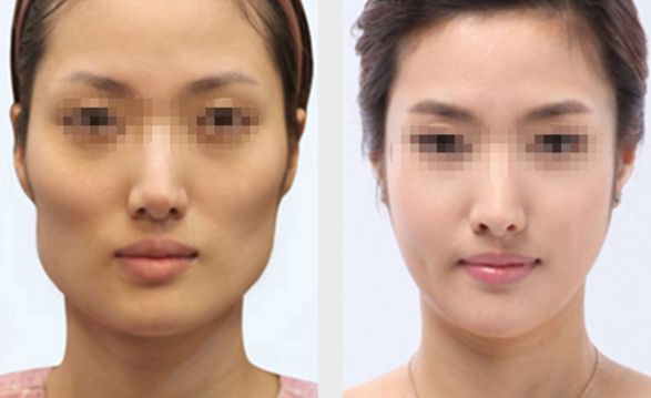 佛山超贊眉間紋填充美容院TOP10推薦