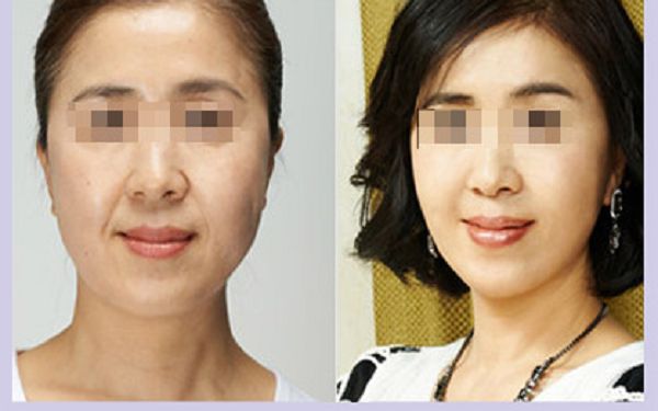 昆明橫向鼻紋整形醫(yī)院推薦榜：實(shí)力機(jī)構(gòu)盤(pán)點(diǎn)