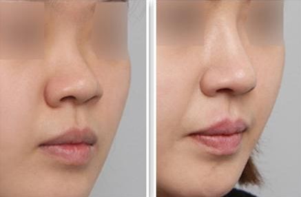 韓國眼皮微整形醫(yī)院綜合排名，精選優(yōu)質(zhì)機構(gòu)助你煥新容顏！