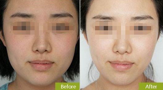 青島正規(guī)除皺針祛眶下皺紋醫(yī)院推薦 TOP 10