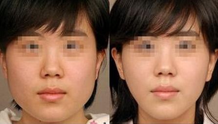 昆明哪家整形醫(yī)院口碑比較好？胸部抽脂術(shù)前10強榜單揭曉！