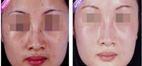 長沙除眼紋醫(yī)院排行榜前十名推薦！