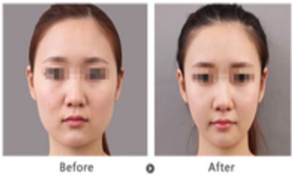 佛山自體脂肪填充修復痘疤醫(yī)院前十強名單出爐！