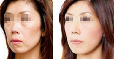 威海隆鼻美容院，專業(yè)技術(shù)引領(lǐng)潮流！