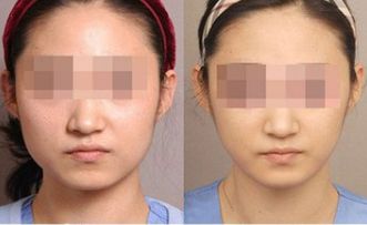 襄陽玻尿酸前額填充整形機(jī)構(gòu)十強精選指南