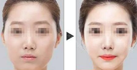 重慶治療痘坑的激光美容醫(yī)院排名前10，技術(shù)一流！