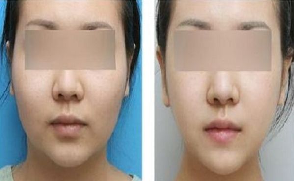 溫嶺頸部肉毒素注射醫(yī)院排行榜：TOP10正規(guī)整形醫(yī)院揭秘！