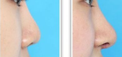 武漢江城整形醫(yī)院：公立醫(yī)院磨骨、隆胸、隆鼻值得推薦嗎？