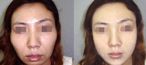 杭州腋臭治療點(diǎn)陣微針射頻醫(yī)院排名榜單更新