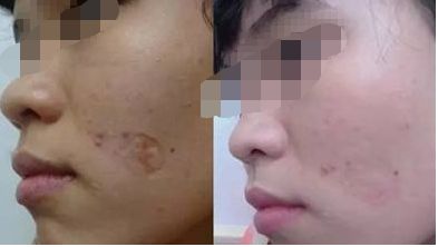 南充值得信賴的無(wú)痕雙眼皮醫(yī)院精選榜單，助你桃花眼魅力升級(jí)