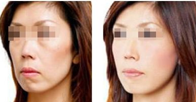 告別痘疤，護膚智慧助你重獲水嫩肌膚！