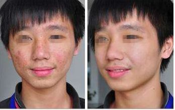 寧波雙眼皮整形醫(yī)院口碑前十精選，助你打造完美眼眸