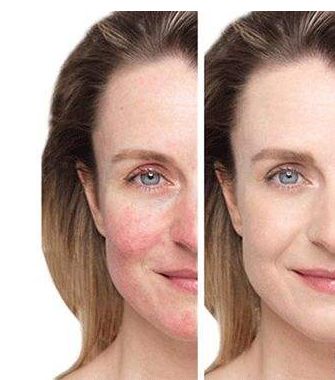 昆明哪家激光祛魚(yú)尾紋醫(yī)院口碑比較好？排名前10名名單揭曉！