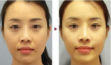 嘉興減淡川字紋：十大醫(yī)療整形醫(yī)院排行榜