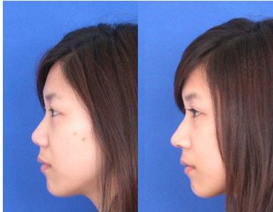 杭州下眼皮皺紋激光修復(fù)醫(yī)院精選TOP10，超值優(yōu)惠等你來！