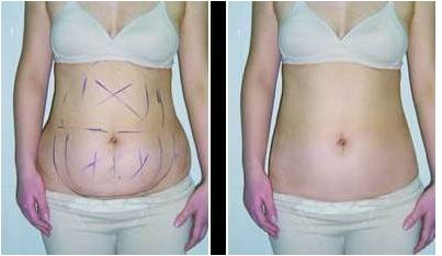 杭州腹部整形醫(yī)院口碑排名前10大揭秘，精準解讀實力榜單