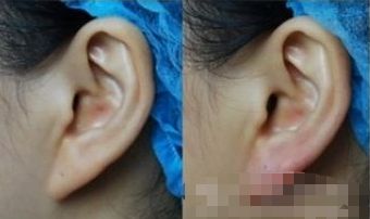 深圳下巴填充膠原蛋白醫(yī)院推薦：前十名不容錯(cuò)過