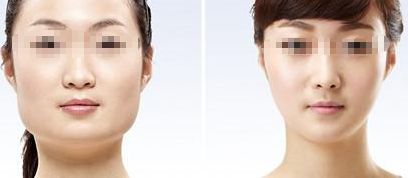 合肥填充脂肪妊娠紋治療醫(yī)院排行榜【2024最新版】