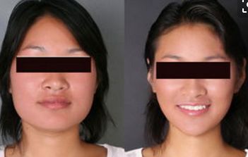 揭秘十堰鼻基底填充口碑佳的十強(qiáng)美容機(jī)構(gòu)