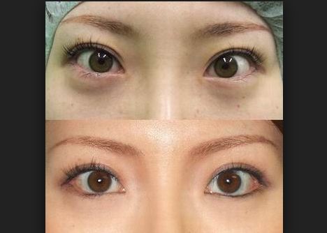 山西眼角祛皺技術(shù)排行前10，醫(yī)院技術(shù)解析！
