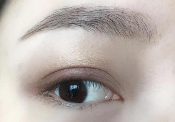 什么是歐式雙眼皮？歐式雙眼皮大概多少錢？