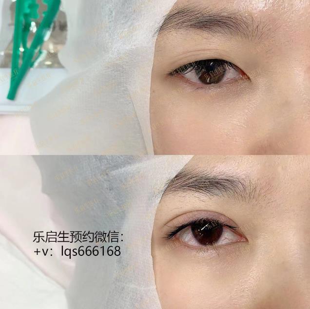 樂啟生周小生醫(yī)生無痕雙眼皮是永久的嗎？會(huì)不會(huì)變成內(nèi)雙呢？