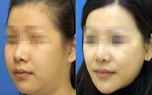 2023齊齊哈爾眼窩凹陷填充手術(shù)醫(yī)生前10名上榜清單專家點評！周冉、曹志雄、李庸國在榜，快來看！