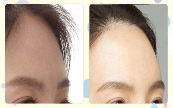 云南射頻微針去痘坑醫(yī)生