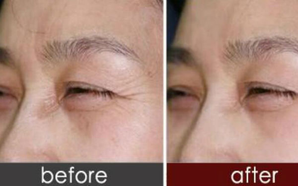 2023佛山微創(chuàng)小切口雙眼皮醫(yī)生強(qiáng)榜前10位全網(wǎng)安利邱群英、劉云忠、雷朝勇值得信賴~