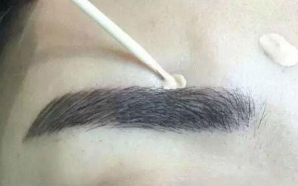 南京熱拉提祛肥胖紋醫(yī)生