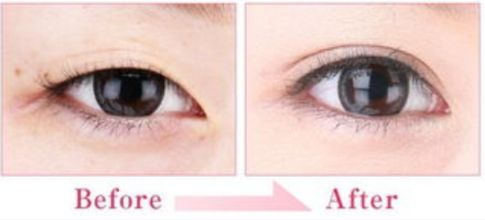 阜陽(yáng)像素激光除皺醫(yī)生