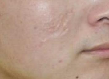 2023永州冷凍吸脂瘦大腿醫(yī)生前十口碑榜分享！呂劍波、何琦蕾、龔佳勝憑高口碑入選