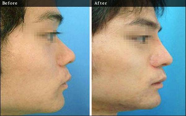 濟南面頰吸脂醫(yī)生