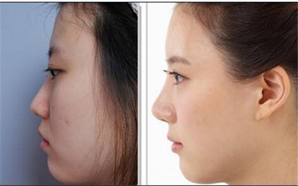 南京填充去淚溝醫(yī)生