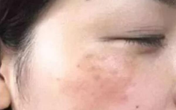 南京皮秒去頸部皺紋醫(yī)生