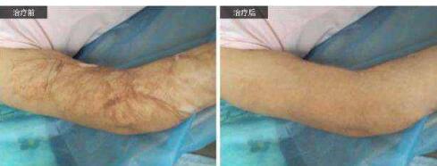 寧波激光脈沖祛雀斑2023價(jià)格表明細(xì)參考(寧波人民醫(yī)院激光脈沖祛雀斑參考價(jià)：5332元)