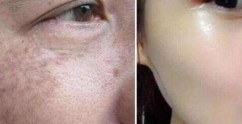 天津自體脂肪填充頸脖紋費用及注意事項(天津濱海醫(yī)院整形美容中心自體脂肪填充頸脖紋參考價：6644元)