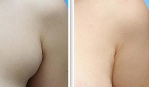 深圳光雕溶脂瘦腰價(jià)格