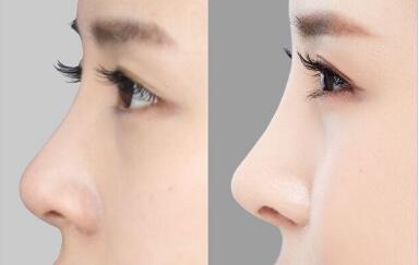 大連手術(shù)消除抬頭紋的價(jià)格是多少明細(xì)公開(大連新明美醫(yī)療美容門診部手術(shù)消除抬頭紋參考價(jià)：5727元)