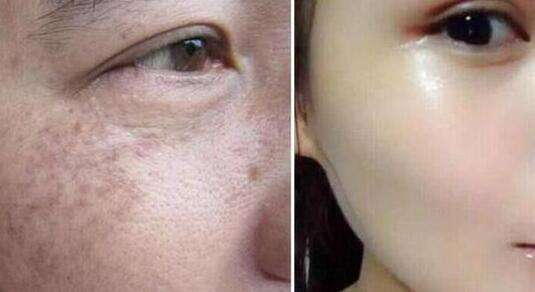 西安生長紋填充脂肪2023收費標準詳細展示(西安邵醫(yī)生整形美容中心生長紋填充脂肪參考價：4305元)